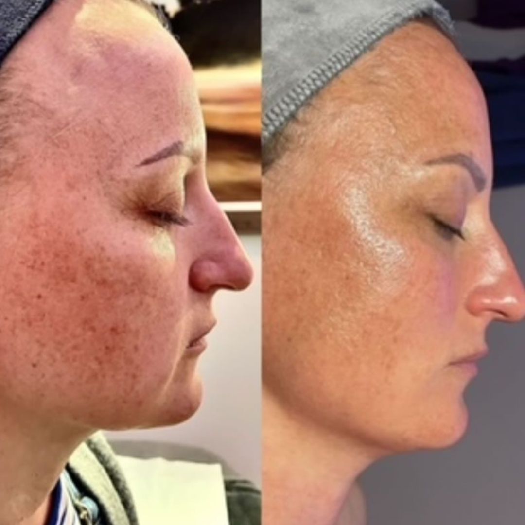 neogen pigmentation treatment