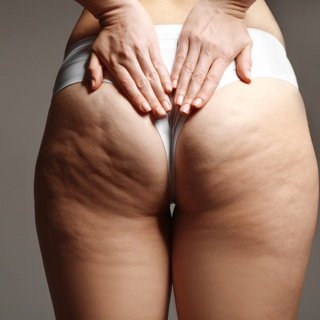 cellulite2