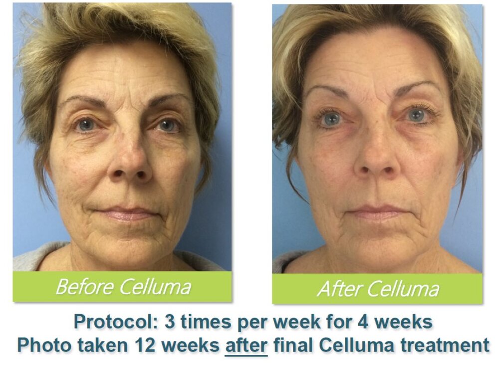 before and after led light therapy celluma tampa 4
