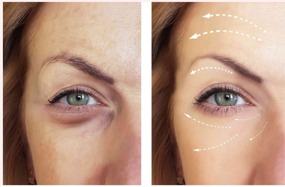 before and after lumi eye