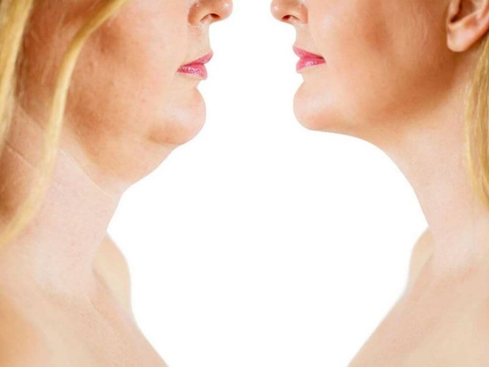 fat+dissolving+chin
