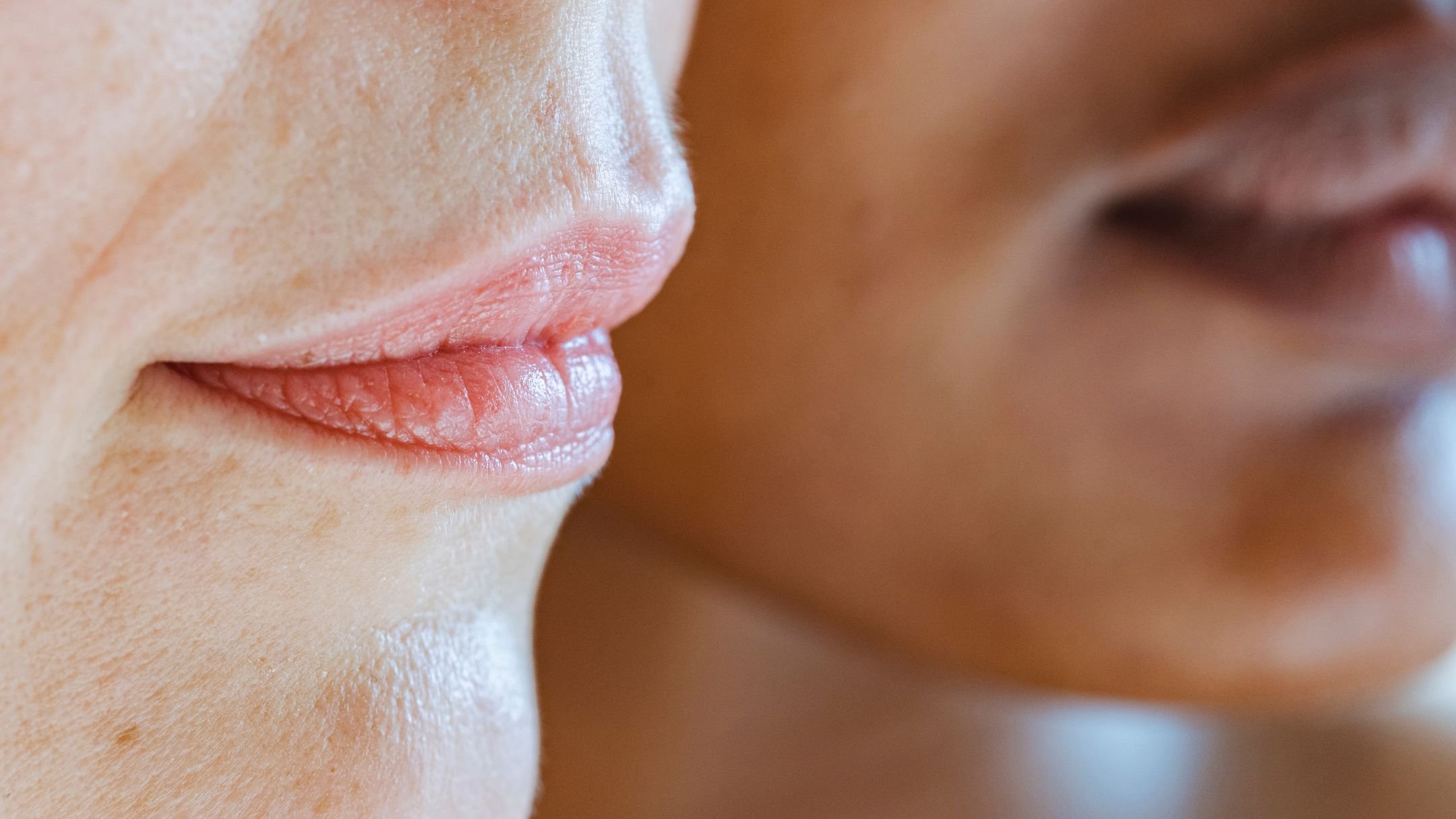 hyperpigmentation