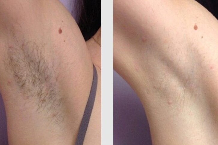 laser hair removal before after