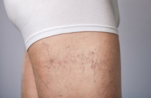 leg vein removal saffron walden