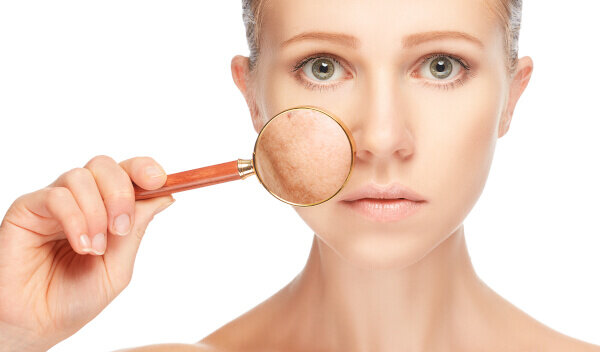 pigmentation+chemical+peel